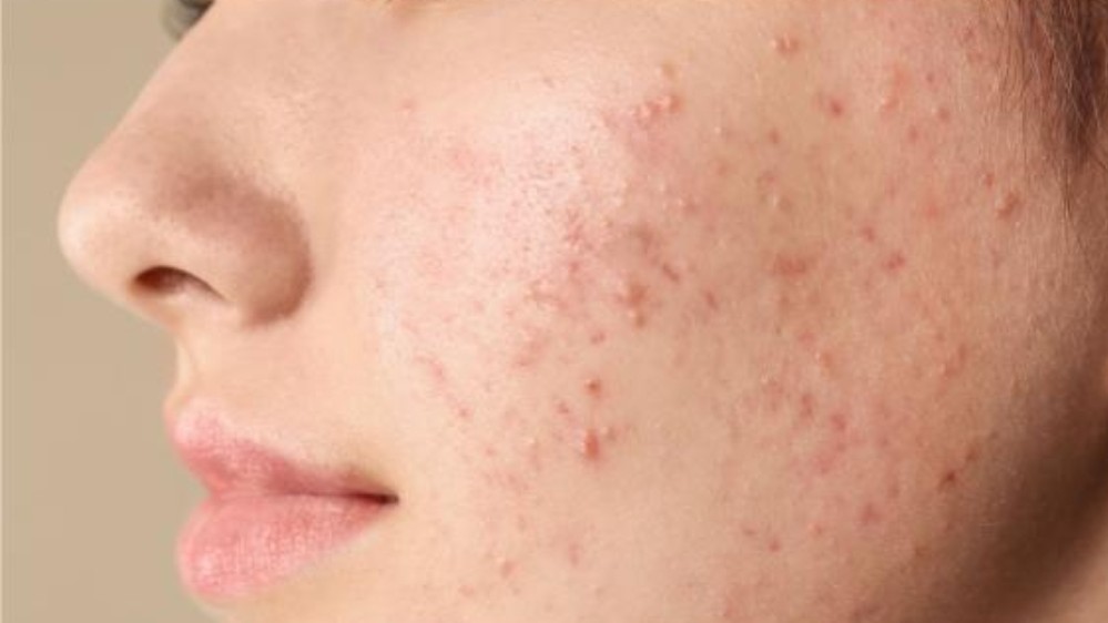 بررسی عوامل ایجاد کننده جوش صورت