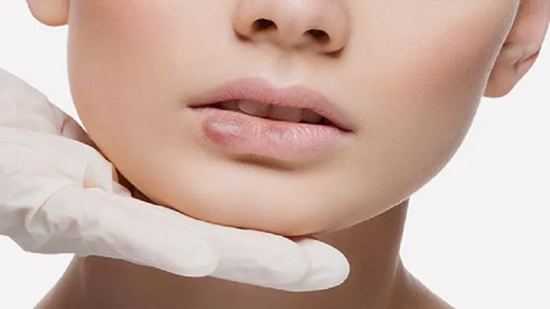 گرانولوم ناشی از تزریق لب چیست؟ [5+ راه پیشگیری از آن]