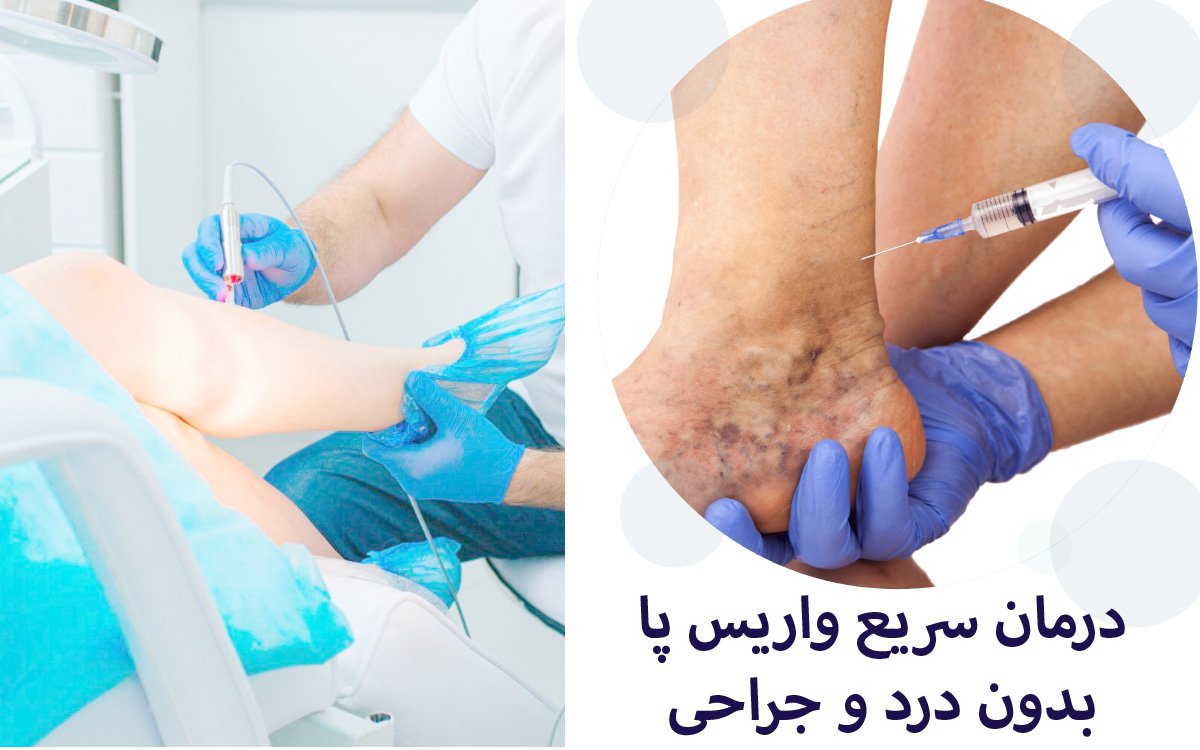 واریس پا را با این روش‌ها آسان و بدون درد درمان کنید!