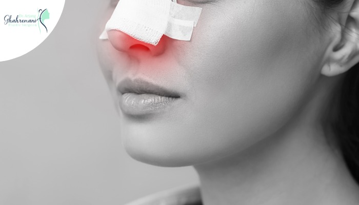 مراقبتهای مهم بعد از عمل بینی برای نتیجه بهتر