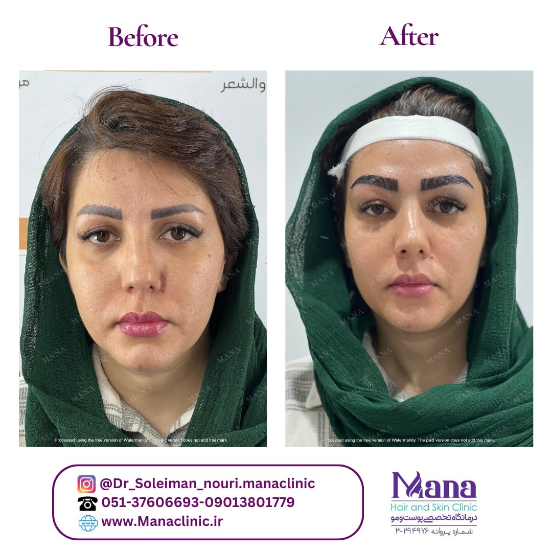 کاشت ابرو در مشهد