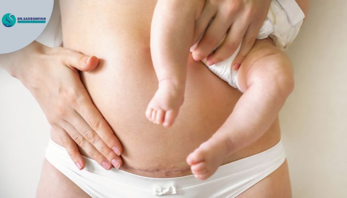 سفتی شکم چه مدت ادامه دارد؟