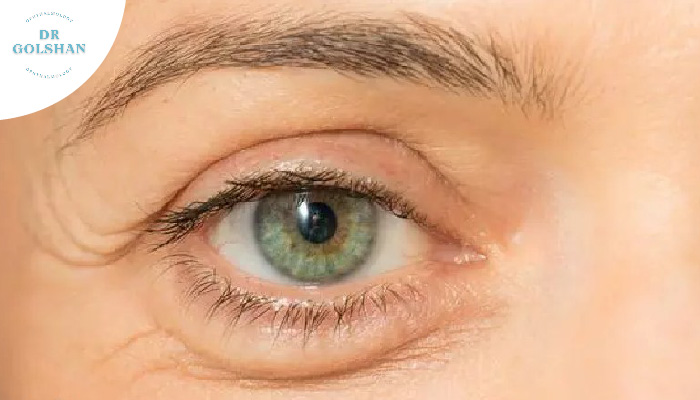 تفاوت پف و کیسه چشم