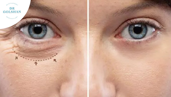 چه زمانی به جراحی بلفاروپلاستی نیاز داریم؟