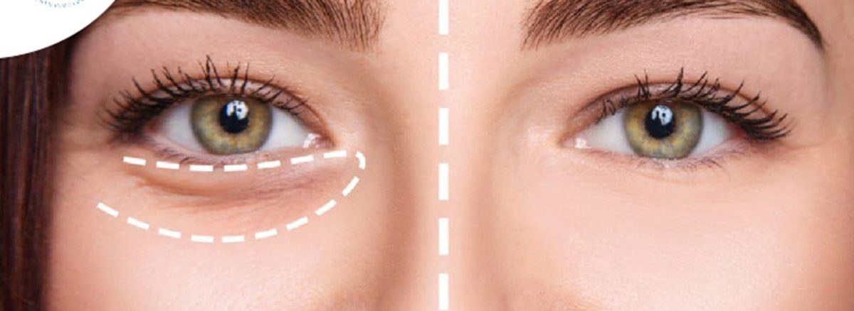 پف زیر چشم را چطور از بین ببریم؟