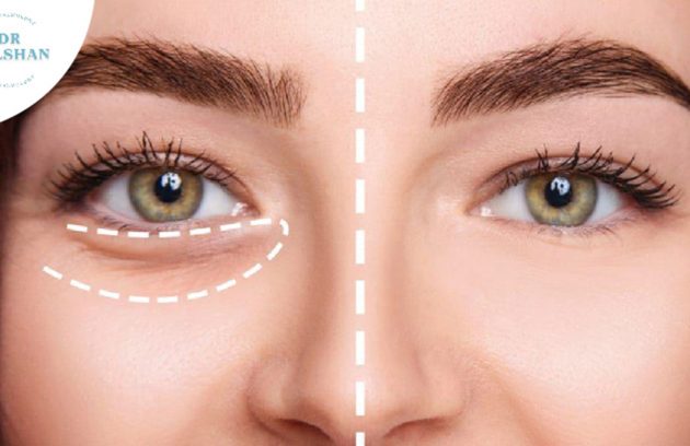 پف زیر چشم را چطور از بین ببریم؟