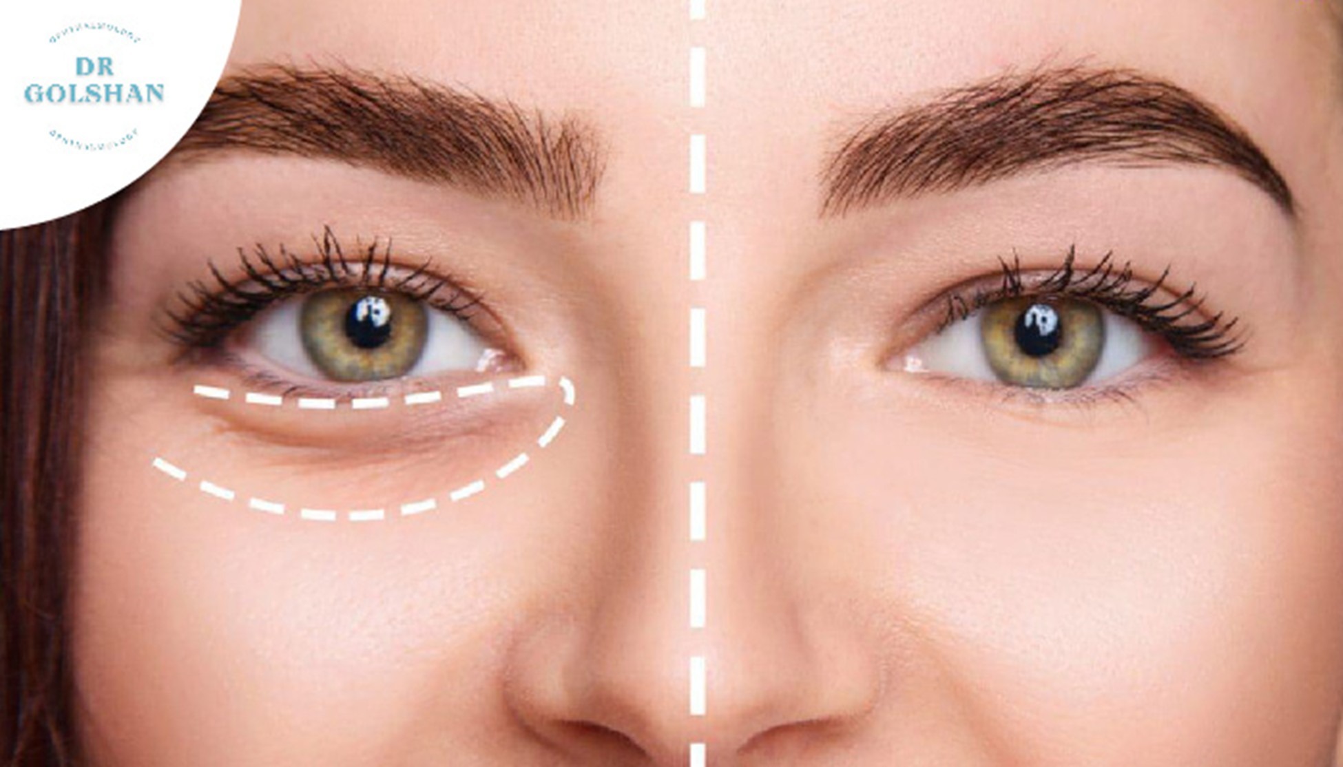 پف زیر چشم را چطور از بین ببریم؟