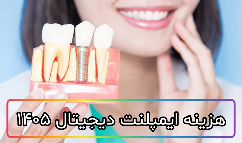 قیمت ایمپلنت دیجیتال