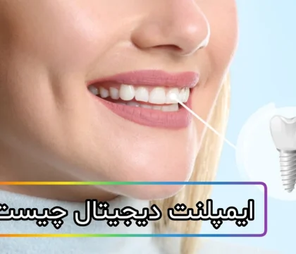 ایمپلنت دیجیتال چیست و چگونه انجام می‌شود؟