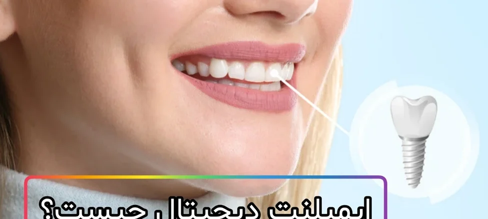 ایمپلنت دیجیتال چیست و چگونه انجام می‌شود؟