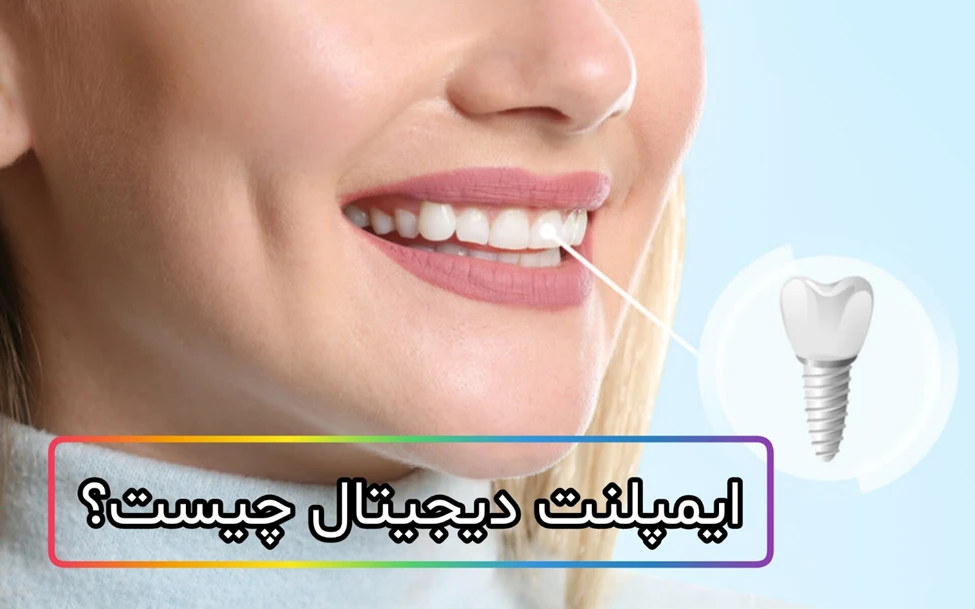 قیمت ایمپلنت دیجیتال 1405 + تفاوت ایمپلنت دیجیتال با معمولی